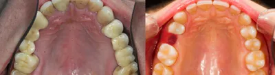 Особенности удаления нижнего зуба мудрости - Стоматология Aliksma