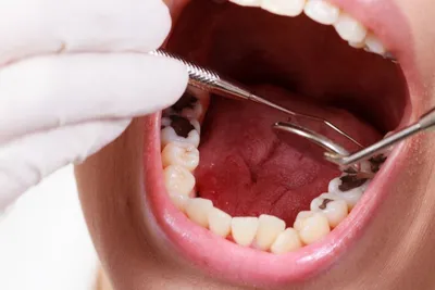 Кариес зуба мудрости — лечение или удаление, симптомы и осложнения