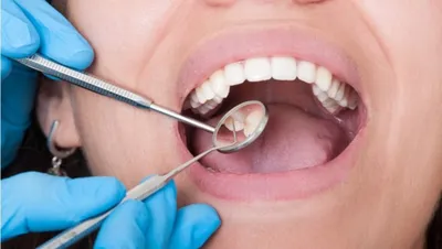 Нужно ли удалять зубы мудрости? | НоваДент