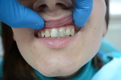 Лечение зуба мудрости, поврежденного кариесом