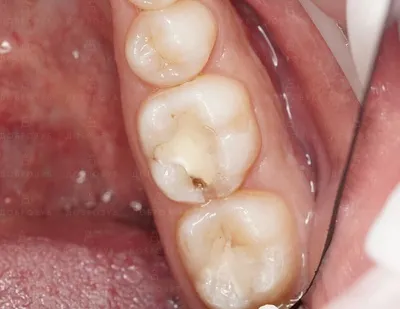 Лечение скрытого кариеса между зубами - Nano Clinic
