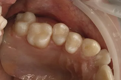 Как предотвратить кариес? | стоматология Рица
