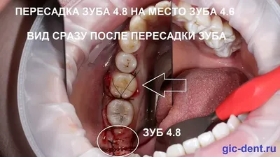 Лечение кариеса: цена в Киеве - Стоматология Доброзуб