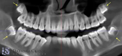 Лечение глубокого кариеса на 27 зубе, фото до и после, пример работы 29414