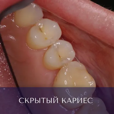 Пришеечный кариес зубов – причины, симптомы, лечение в Москве – цены,  отзывы в стоматологических клиниках Зуб.ру