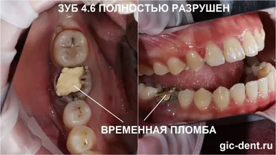 Имплантация собственных зубов. Пересадка зубов мудрости в ТОП1 клинике  Москвы – Немецкий имплантологический центр