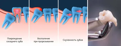 Из-за чего зуб черный? - Терапия - Форум стоматологов (стомотологический  форум) - Профессиональный стоматологический портал (сайт) «Клуб  стоматологов»