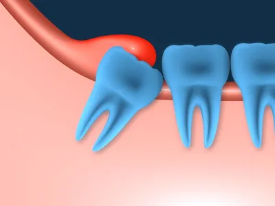 Лечение глубокого кариеса на жевательном зубе: выполненная работа с фото до  и после в стоматологии OneDent