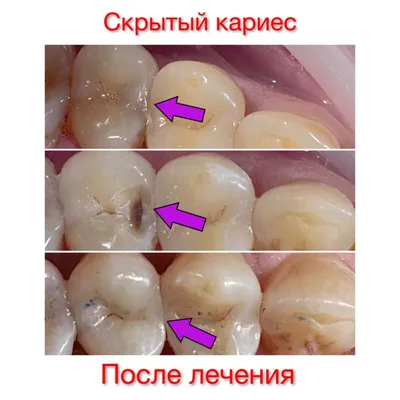 ЧЕМ ОПАСЕН СКРЫТЫЙ КАРИЕС? ИСТОРИЯ НАШЕГО ПАЦИЕНТА, КОТОРЫЙ СЧИТАЛ, ЧТО ОН  ПОЛНОСТЬЮ ЗДОРОВ! - Стоматология \"Лазурит\" в Обнинске - лечение зубов и  десен