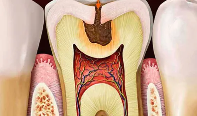 Кариес - причины развития, стадии и симптомы, осложнения, лечение и  профилактика