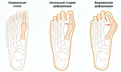 Виды деформаций стоп — Авиценна