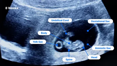 What Can I See On an 8-Week Ultrasound?