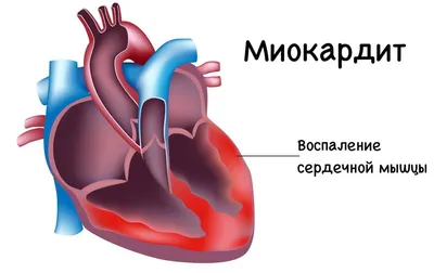 Боль в груди (в области сердца): причины в Иркутске в Клинике Эксперт