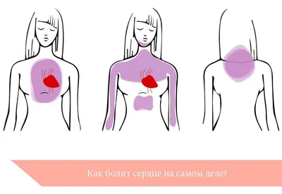 Болит живот или сердце? Абдоминальная форма инфаркта миокарда