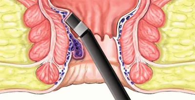 Геморрой: что значит, симптомы заболевания, лечение