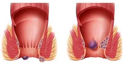 Всем, кто просил для друга. Лечим геморрой | Пикабу