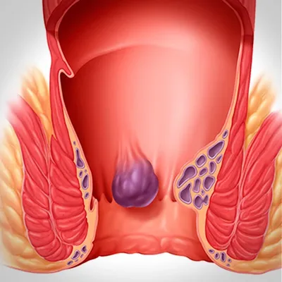 Симптомы и лечение геморроя у женщин в Симферополе