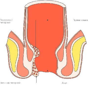 Лечение внутреннего геморроя у женщин в Ростове по выгодной цене -  Doctor-Prof