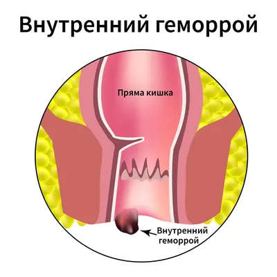 Геморрой: причины, симптомы, стадии, виды, осложнения, профилактика
