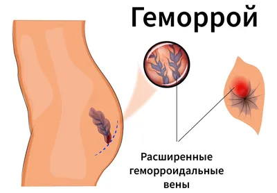 Лечение геморроя и анальных свищей лазером — ИСЦ