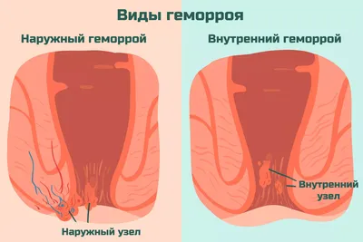 Причины возникновения геморроя, способы лечения гемороя