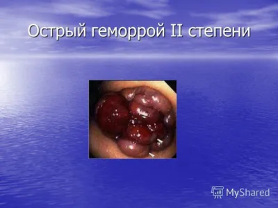 Лечение геморроя - Медицинский центр \"Мирт\"