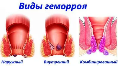 Профилактика геморроя: как не заработать неприятную болезнь