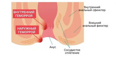 Геморрой лечение геморроя у мужчин и женщин в Москве цена в Клинике ABC