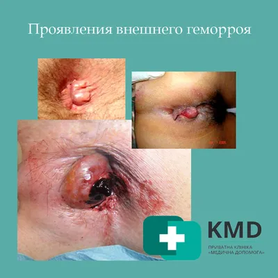 Геморрой