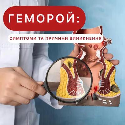 Наружный геморрой - причины и методы лечения