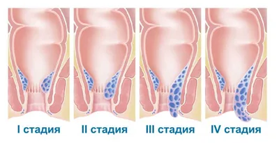 Геморрой: что такое? Как бороться? - статьи от компании Еламед