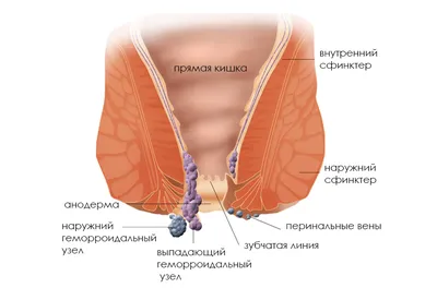 Наружный геморрой (внешний): основные причины и лечение