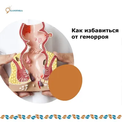 Геморрой после операции: способы лечения, диета - Клиника Доктора Гришина
