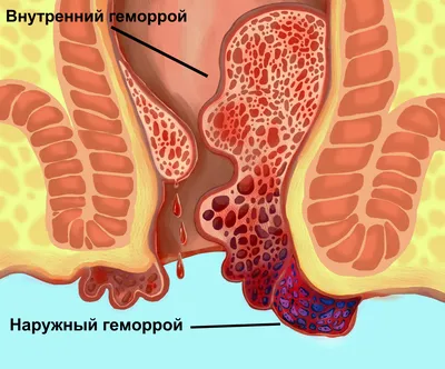 Наружный геморрой: симптомы и методы лечения