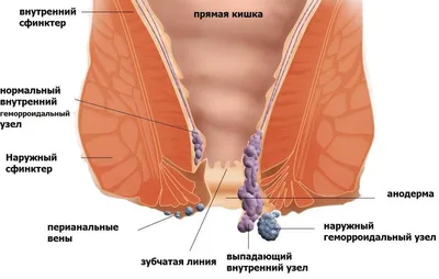 Геморрой - симптомы, лечение, причины и профилактика геморроя - Гармония