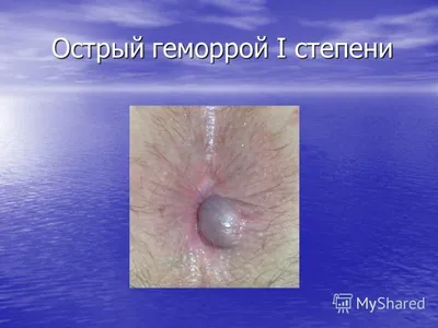 Геморрой — (клиники Di Центр)