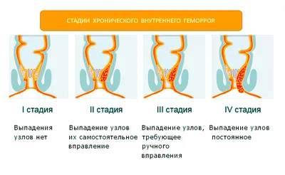 Мазь и свечи ПроктоГливенол от геморроя