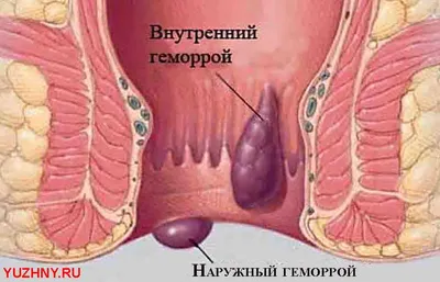 Лечение геморроя | клиника \"Скандинавия\"