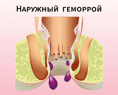 Геморрой как он есть и как его лечить, чтобы не было мучительно больно