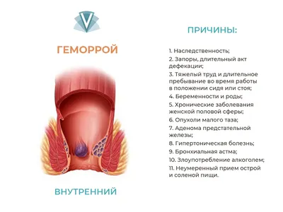 Геморрой — симптомы и лечение геморроя