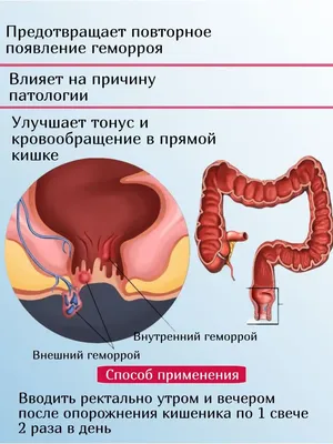 ТОП-10 мазей от геморроя: что лучше по мнению проктологов