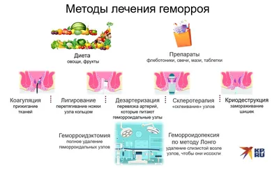Геморрой – симптомы, причины, как лечить