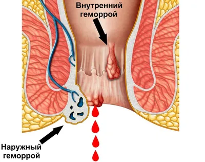 5 полезных упражнений при геморрое | Клиника Medimax в Ташкенте