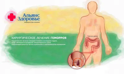 Наружный (внешний) геморрой: симптомы, как выглядит, что делать, лечение,  профилактика