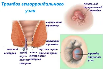 Эффективное лечение внутреннего геморроя - блог Виртус