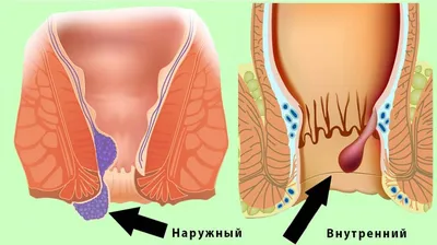 Геморрой у мужчин и женщин - суть проблемы, причины, симптомы, стадии,  лечение | Mednavigator.ru | Дзен