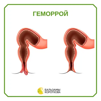 Геморрой симптомы, лечение у женщин и мужчин, какие есть средства,  профилактика