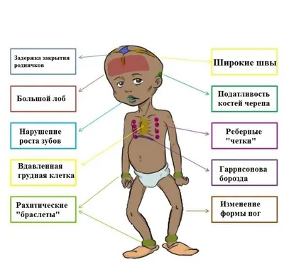 Картинки рахит у детей