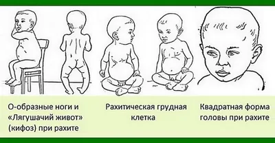 Профилактика рахита у детей
