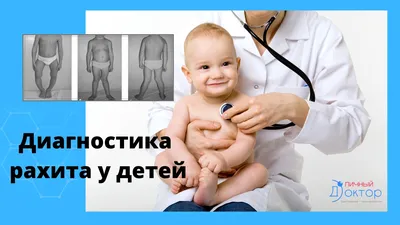 Рахит – известные и неизвестные факты